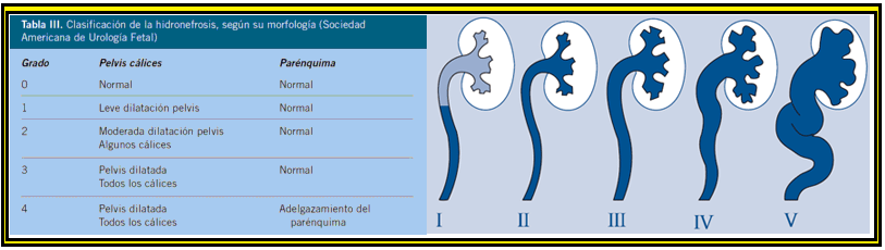 Hidronefrosis clasificación SFU ecografía — grados 1 2 3 4 dilatación calicial | Dr. Segnini
