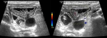 Engrosamiento parietal vejiga cistitis ecografía — hipervascularización Doppler | Dr. Segnini