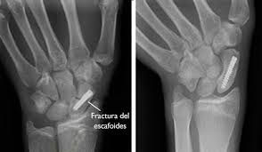 fractura-escafoides-cintura-rx-muneca.jpg | Alt SEO: Fractura de escafoides en cintura — radiografía de muñeca proyección escafoides y PA | Dr. Segnini