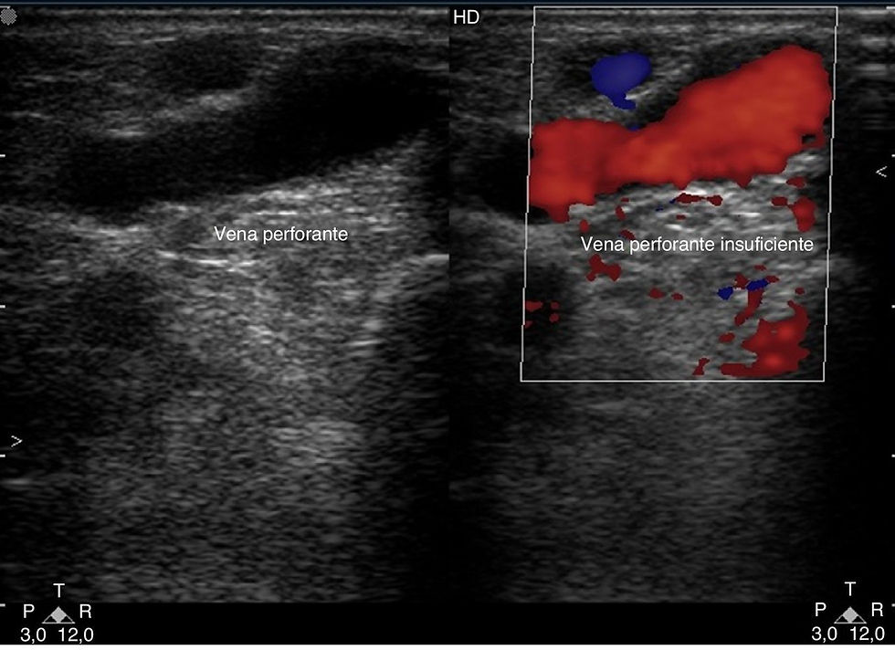 Vena perforante insuficiente ecografía Doppler — reflujo transfascial hacia sistema superficial | Dr. Segnini