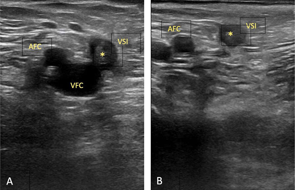 Tromboflebitis vena safena mayor extensión ecografía — clasificación segmento afectado | Dr. Segnini