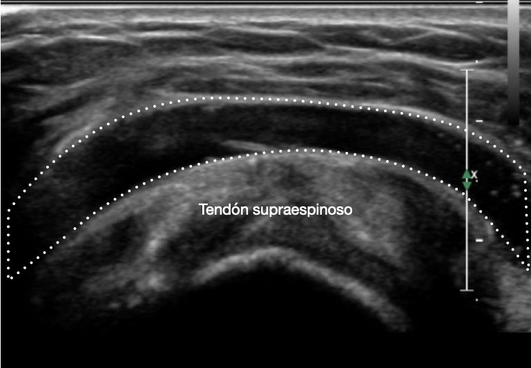 Bursitis subacromial ecografía — derrame bolsa subacromio-deltoidea | Dr. Segnini