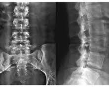 Columna Lumbar: Radiografía, Técnica e Interpretación Sistemática