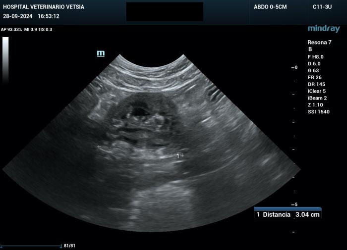 Linfangitis ecografía — diferenciación tromboflebitis superficial edema perivascular | Dr. Segnini