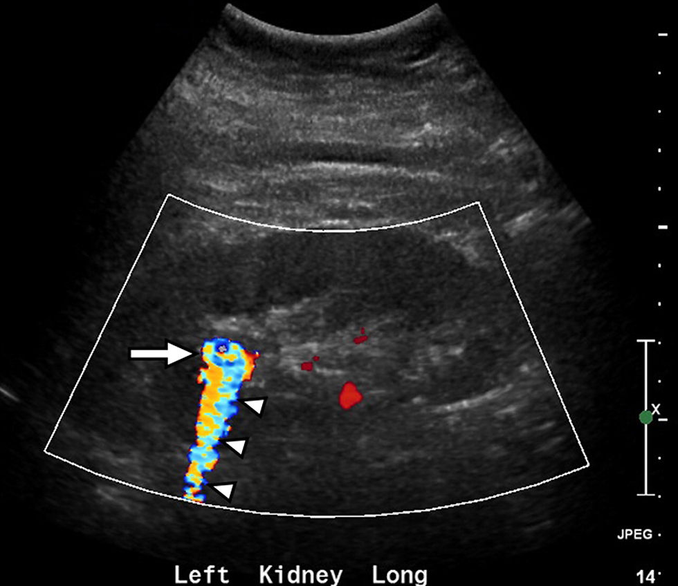 Twinkling artifact Doppler color — artefacto centelleo cálculo renal ecografía | Dr. Segnini