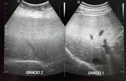Esteatosis hepática grados 1 2 3 ecografía — comparación progresiva ecogenicidad hepática | Dr. Segnini