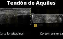 Ecografía tendón Aquiles tendinopatia
