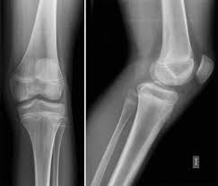 Radiografía de Rodilla: Técnica, Proyecciones e Interpretación Sistemática