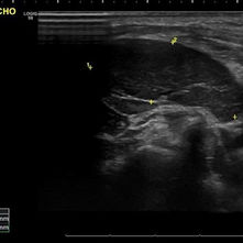 Adenopatías Cervicales: Ecografía y Criterios de Malignidad