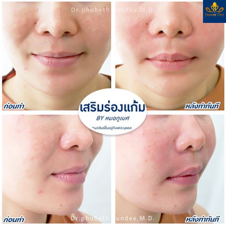 ร่องแก้ม_๒๑๑๑๒๐_22.jpg