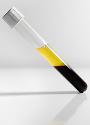 Behandlung mit Eigenplasma, Eigenbluttherapie, Vampir Lifting