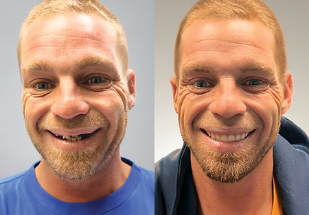 Smile-Stop-Dentures-Implants-DrJohnathanVo6