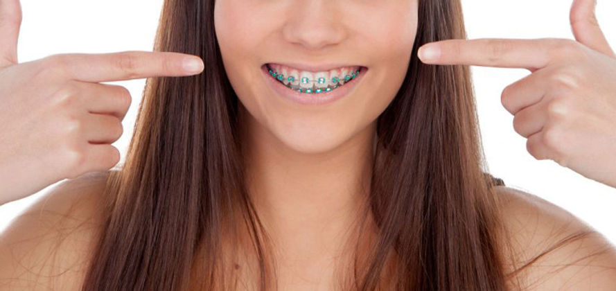 que-son-los-brackets-metalicos.jpg