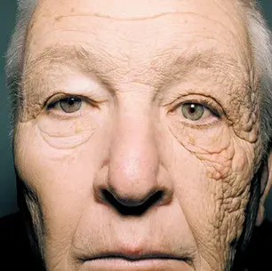 What wrinkles say about your biological age