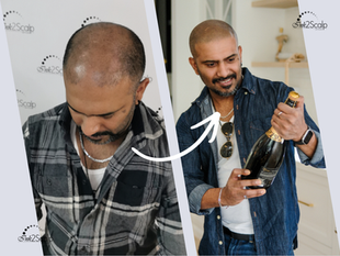 An image showing a "Before and After" transformation of a man who received Scalp Micropigmentation (SMP) from Ink2Scalp. On the left, a "Before" top-down view shows the man with significant hair thinning and a receding hairline. On the right, the "After" shot shows the man smiling and holding a bottle of champagne, sporting a clean, fully restored, and natural-looking buzzed hairline. A curved white arrow points from the "Before" photo to the "After" photo, emphasizing the transformation. The Ink2Scalp logo is visible in the corners of the image.