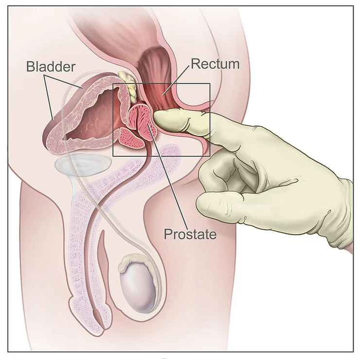 picture of finger finding the prostate