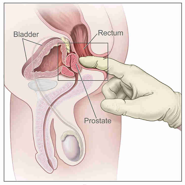 picture of finger finding the prostate