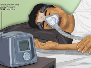 Tirzepatide: The Dreamy Weight Loss Med that could help your Sleep Apnea!