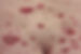 braunfalco_psoriasis.jpg