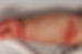 Neurodermitis_edited.jpg