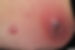 braunfalco_abszess.jpg