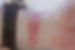 braunfalco_contactdermatitis.jpg
