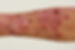 braunfalco_pruritus.jpg