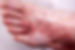 braunfalco_ulcus.jpg