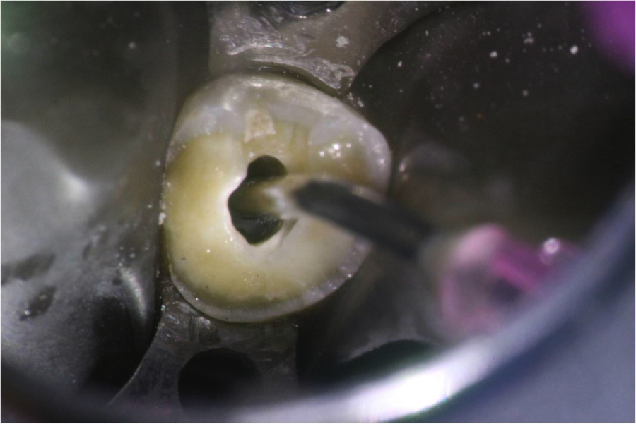 Figure 7: The composite applicator tip fits around the top 3mm of the silver point