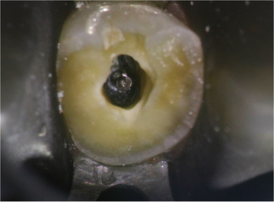Figure 2: silver point within the root canal