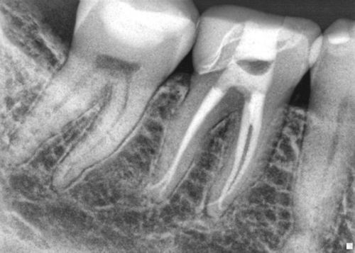Post Operative Radiograph