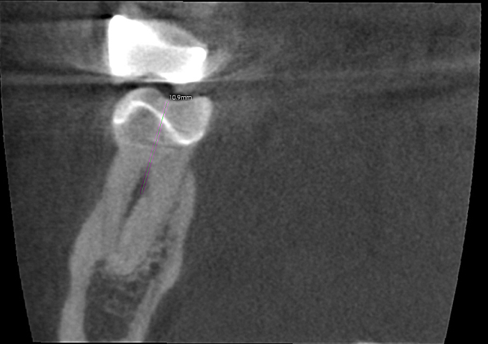 Distal Root, Coronal View, Arrow indicating the lingual split .