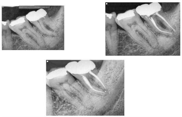 Saving More Teeth! The Periodontic-Endodontic Infection