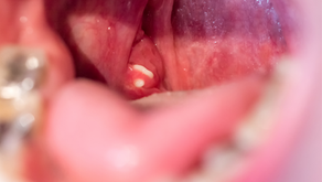 Close-up photo of a human throat showing a visible white tonsil stone lodged in the left tonsil near the back of the mouth.