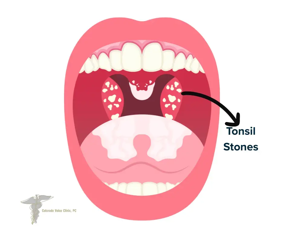 Illustrated open mouth showing enlarged tonsils with multiple white tonsil stones labeled by an arrow pointing to the affected area.