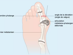 Orthèse plantaire Hallux valgus
