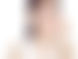 Does Sculptra Fillers Look Natural?