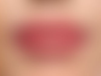 Russian Lip Fillers: Your Passport to Pout Perfection in Dubai