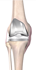 total knee replacement