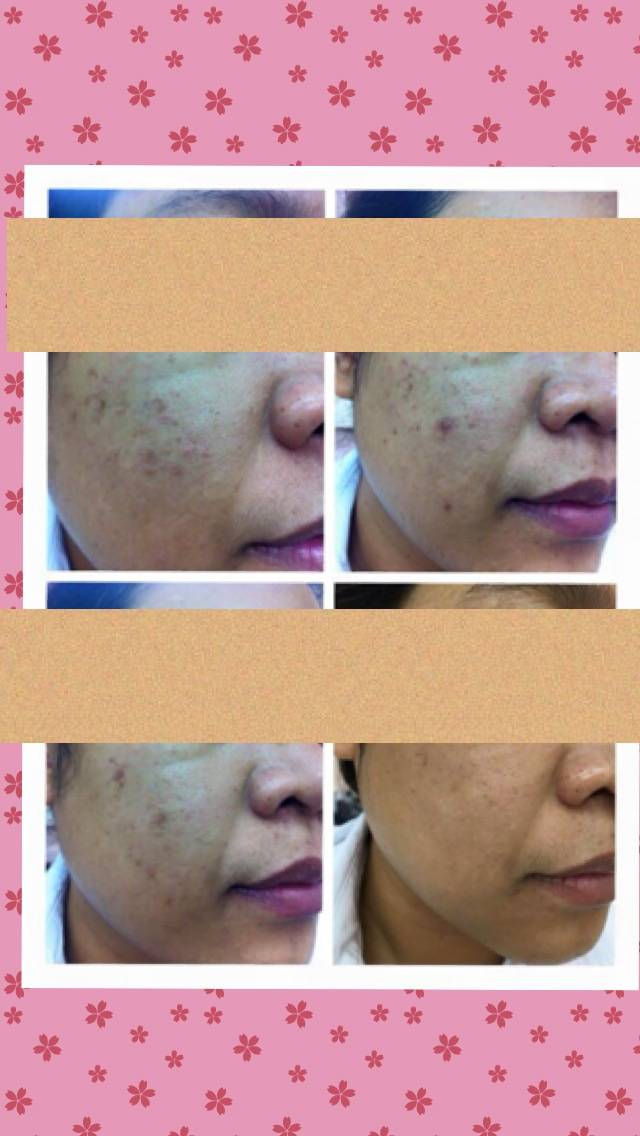 IPL Treatment