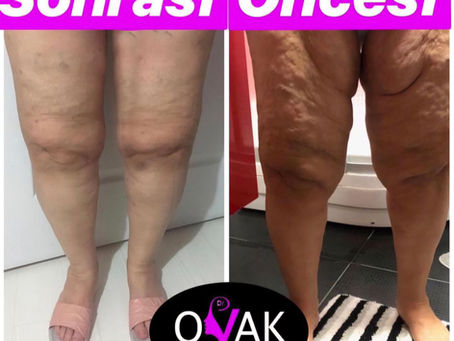 Kopyası: Lipoödem: Kadınlarda Gizli Salgının Cerrahiyle Sessiz Devrimi