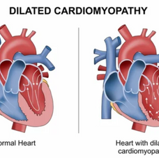 Dilated Cardiomyopathy: A Tale Of An Enlarged Heart