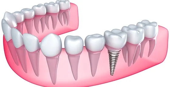 Mercandent Ankara 7 24 Dis Poliklinigi Dis Hekimi Acil Dis Ankara