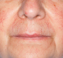 Verwijde vaatjes before