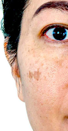 Melasma
