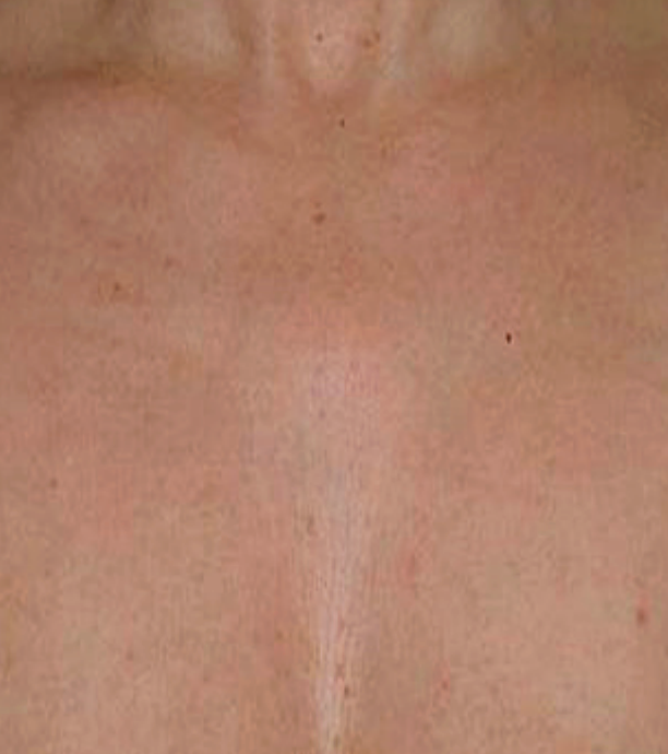 Pigmentvlekken after