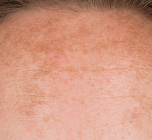Melasma