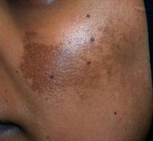 Melasma