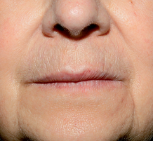 Verwijde vaatjes after