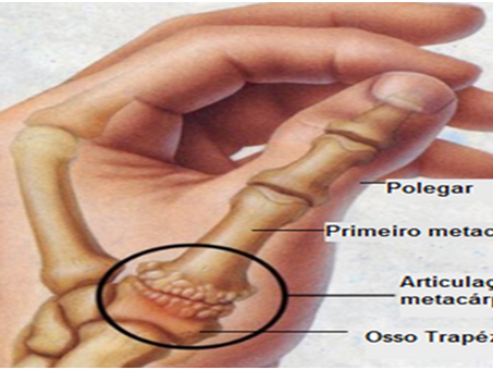 FISIOnews | Rizartrose ou artrose do polegar